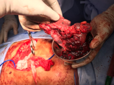 Recurrent and complicated surgeries