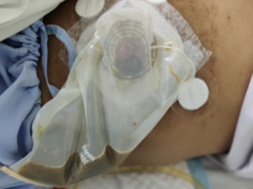 Surgical issues and bowel diversion of spinal cord injured and paralysed patients