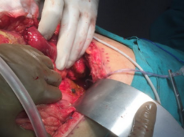 Recurrent and complicated surgeries